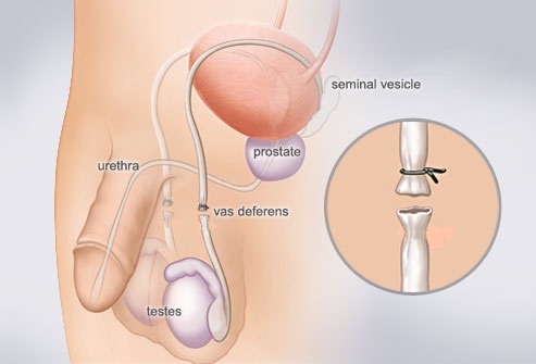 Non Scalpel Vasectomy New Creation MediCosmetic MediCosmetic Centre