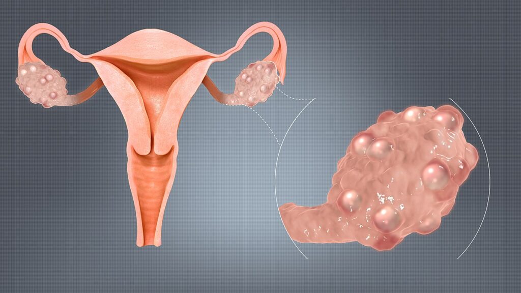 Polycyctic ovary Syndrome